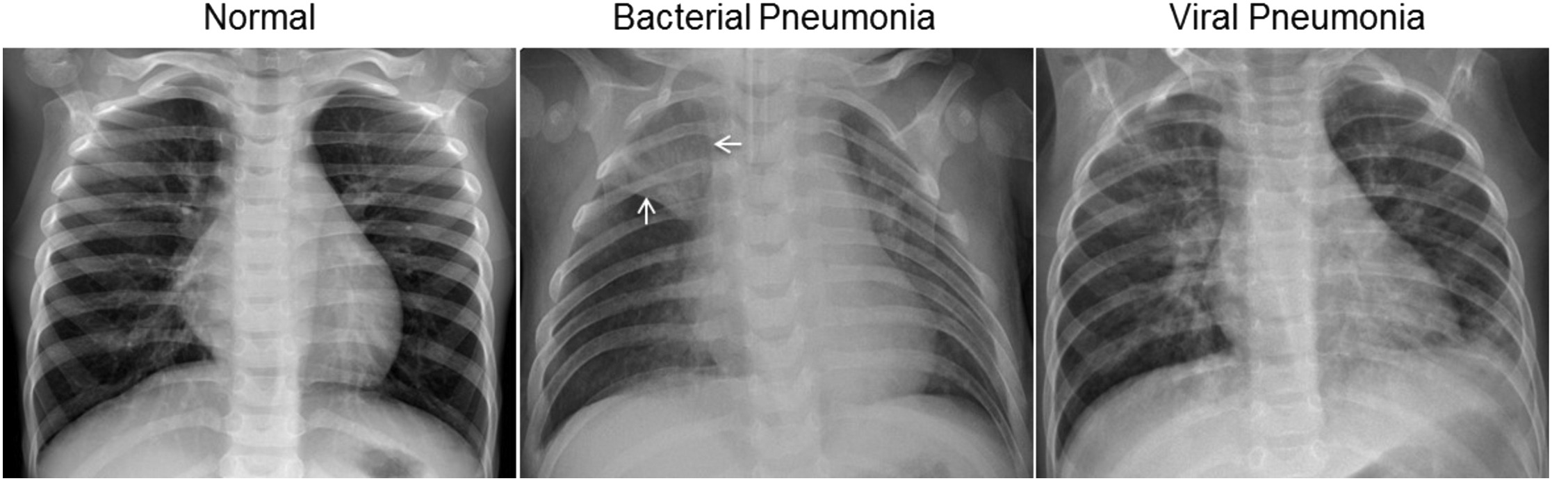 Three chest X-rays side by side: a normal chest with clear lungs, bacterial pneumonia with a focal lobar consolidation and viral pneumonia with a diffuse interstitial pattern in both lungs